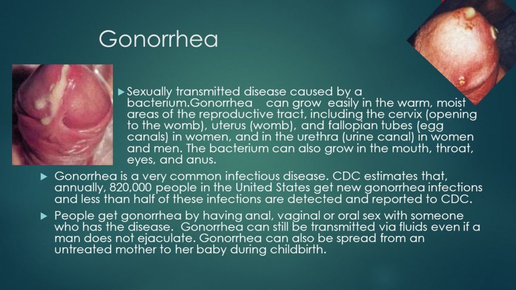 gonorrhea symptoms mouth