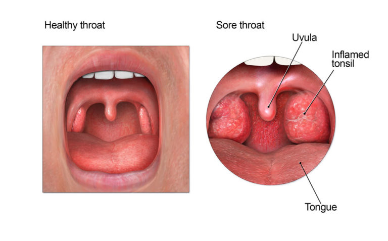 How To Cure A Sore [strep] Throat Fast Public Health