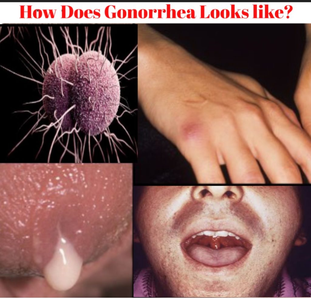 gonorrhea symptoms discharge