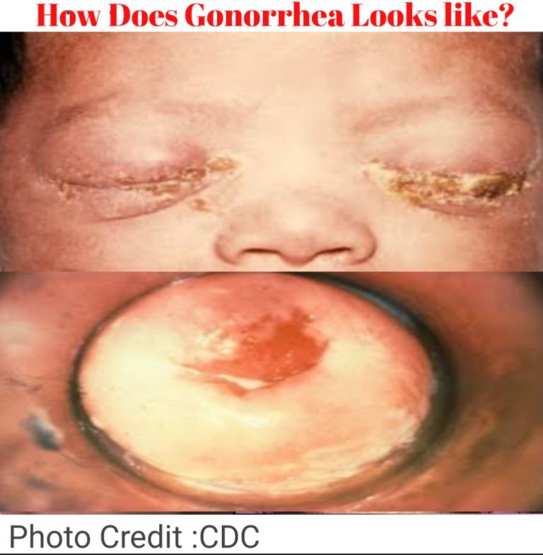 when does gonorrhea symptoms appear