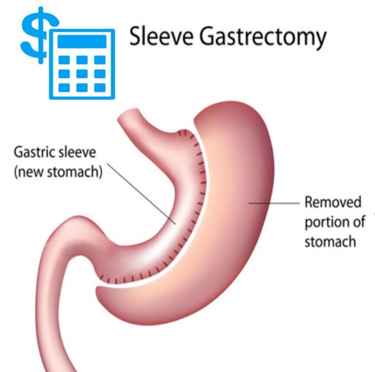 Gastric Sleeve Cost and Success Rate Public Health