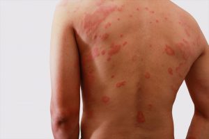 Tramadol Rash pictures