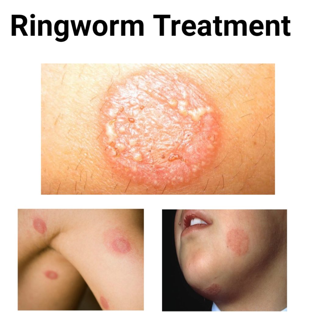 What Is The Best Antifungal Medicine For Ringworm