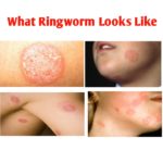 What Does Ringworm Look Like? (Pictured) - Public Health