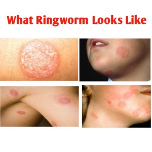 What does ringworm look like | Public Health