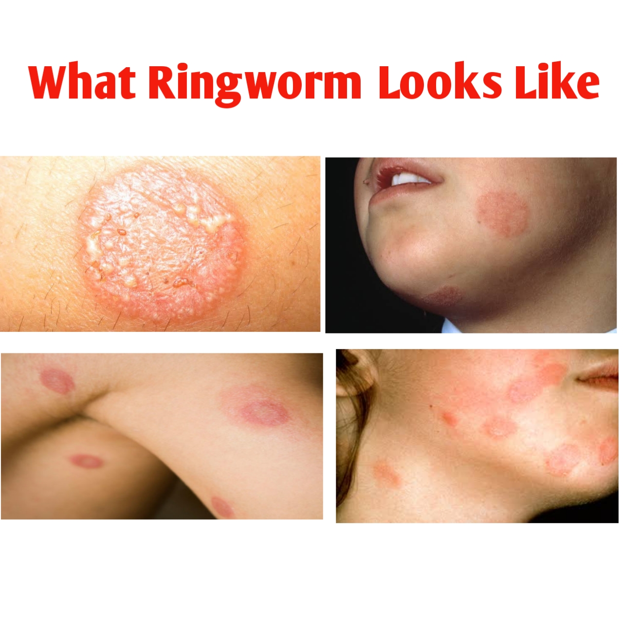 beginning stage of ringworm in humans
