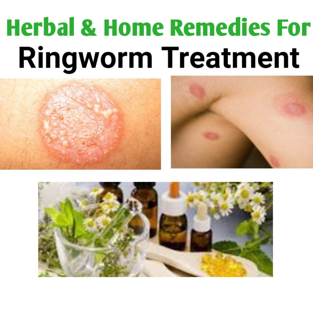 Best Medications For Ringworm Treatment Public Health