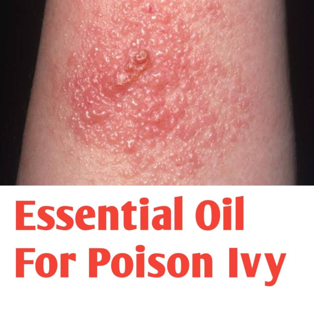 How to Use Essential Oil For Poison Ivy Relief - Public Health