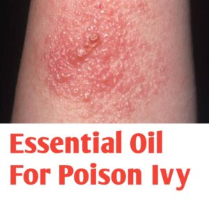 Essential Oil For Poison Ivy | Public Health