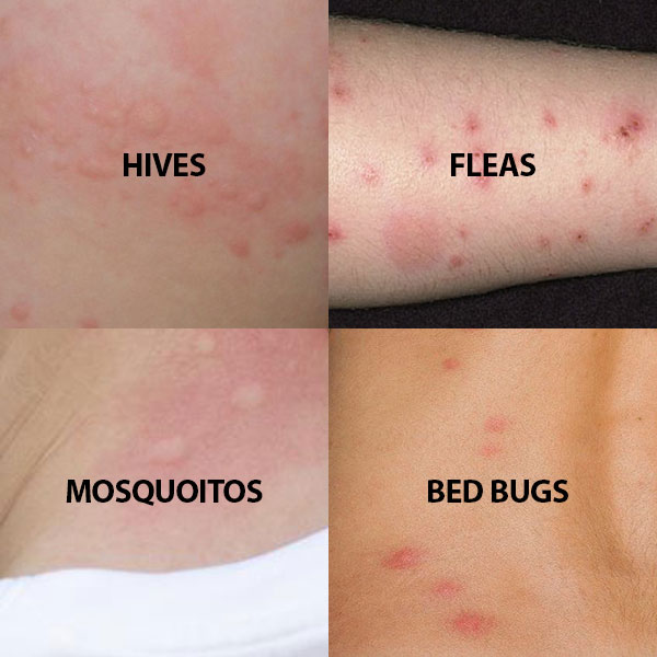does your body reacto to bed bug bites less over time