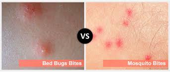 Bed bug bites vs. mosquito bites | Public Health