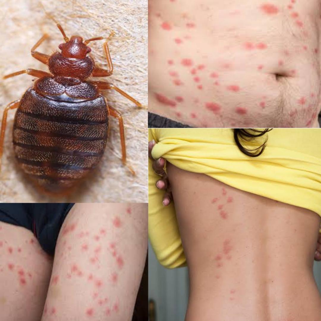 types of bug bites in bed