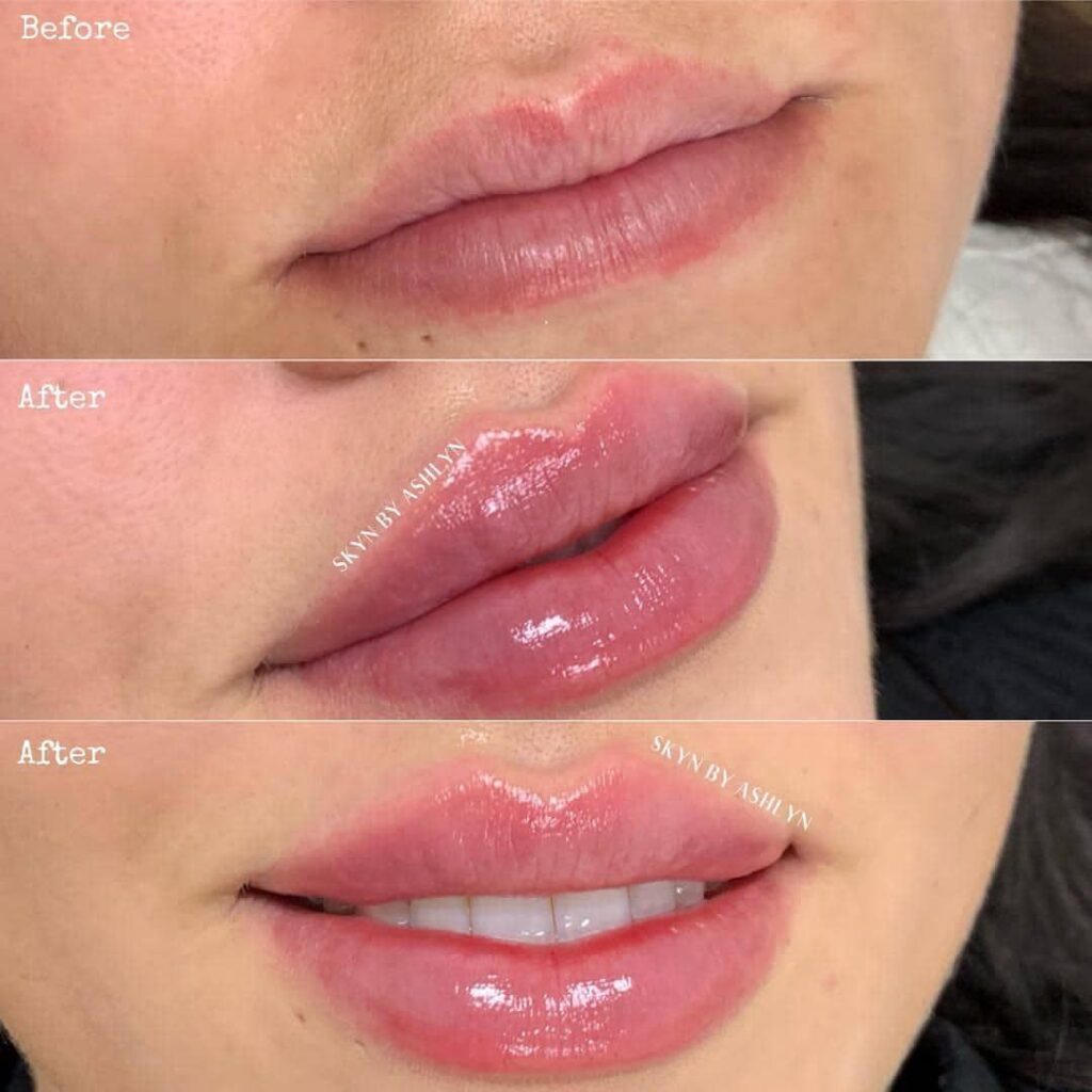 How Long Does Swelling Last After Lip Filler Public Health 