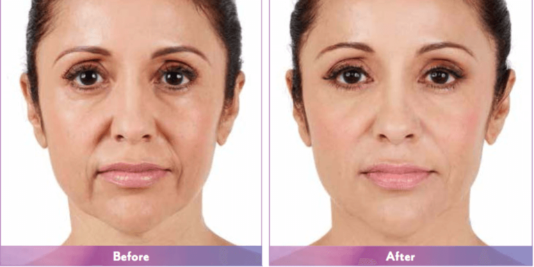 Juvederm before and after picture | Public Health