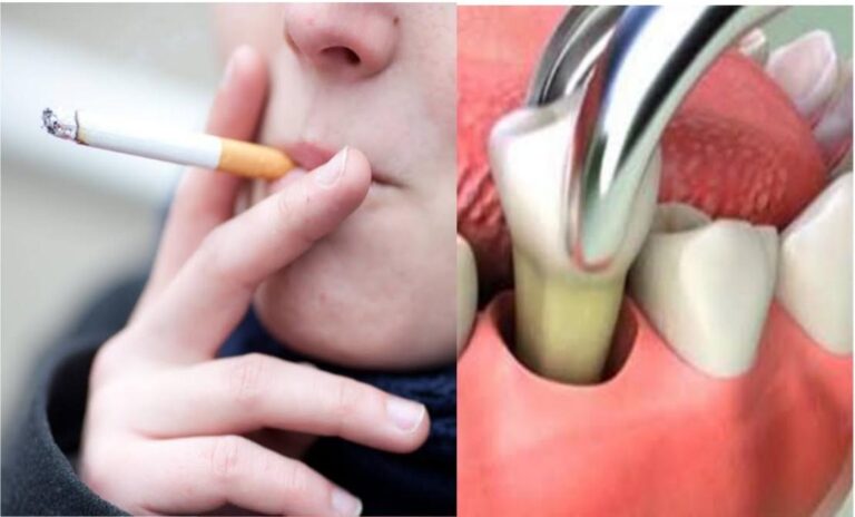 when-can-i-smoke-after-tooth-extraction-public-health