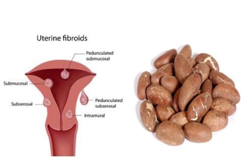 can-bitter-kola-remove-or-shrink-fibroid-public-health