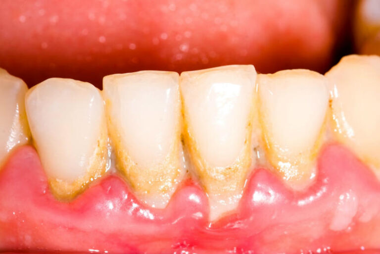 how-to-get-rid-of-calcium-deposits-on-teeth-taylor-hakinge