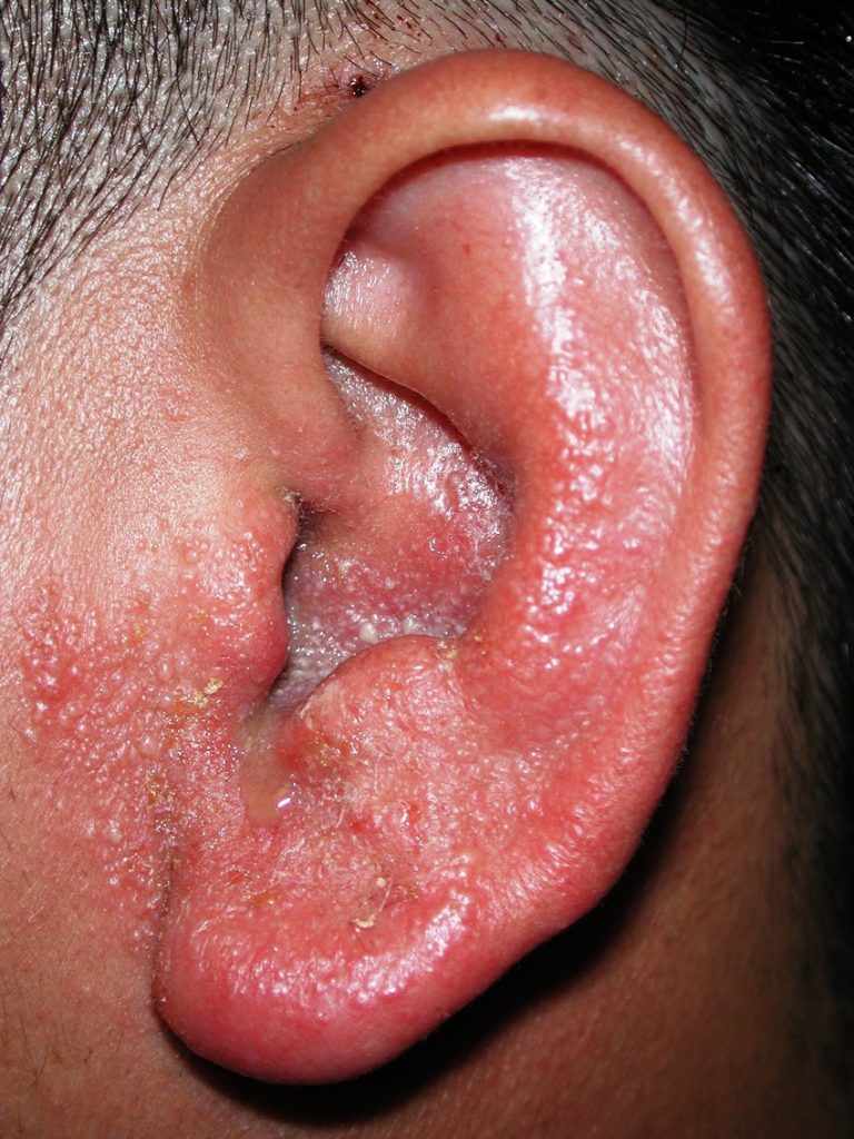 can-allergies-cause-recurring-ear-infections-public-health