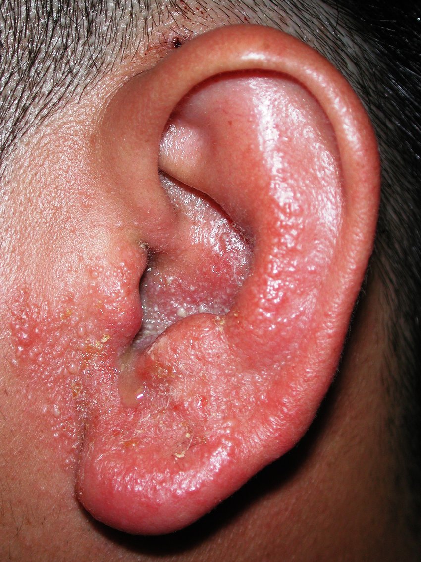 Can Allergies Cause Recurring Ear Infections Public Health