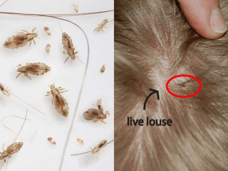 How To Check Yourself For Lice Public Health