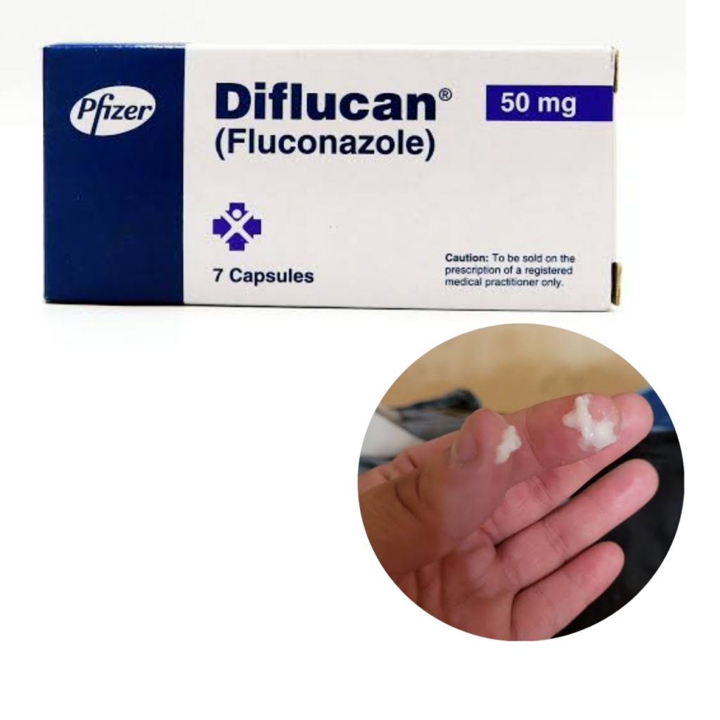 reasons-why-you-have-a-clumpy-discharge-after-taking-fluconazole