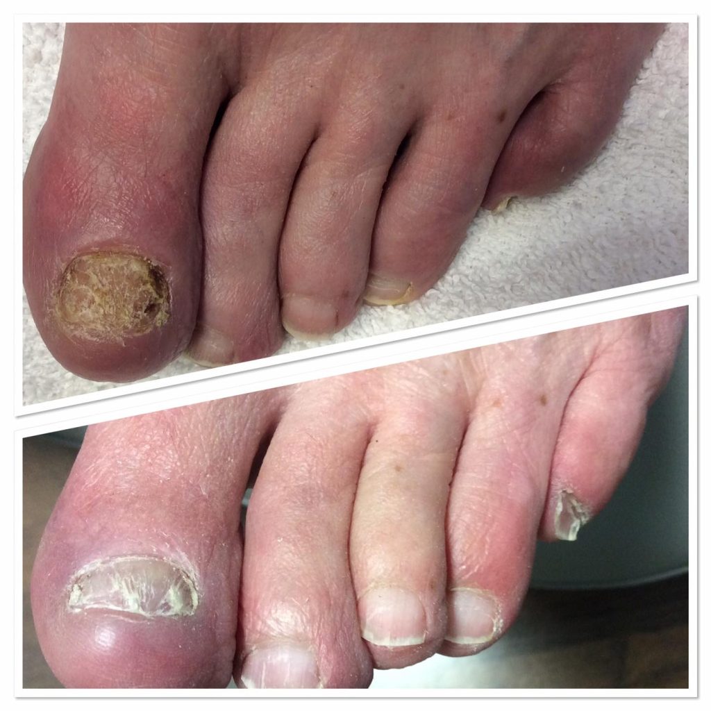 Toenail Fungus Uncovered Causes Symptoms Care Public Health